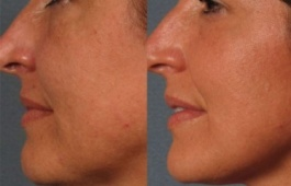 เครื่องทำ IPL Beauty Pigment Skin Skin Rejuvenation Beauty Lip Upper