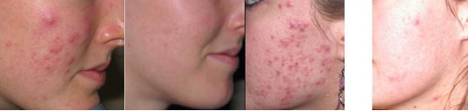 เครื่องทำ IPL Beauty Pigment Skin Skin Rejuvenation Beauty Lip Upper